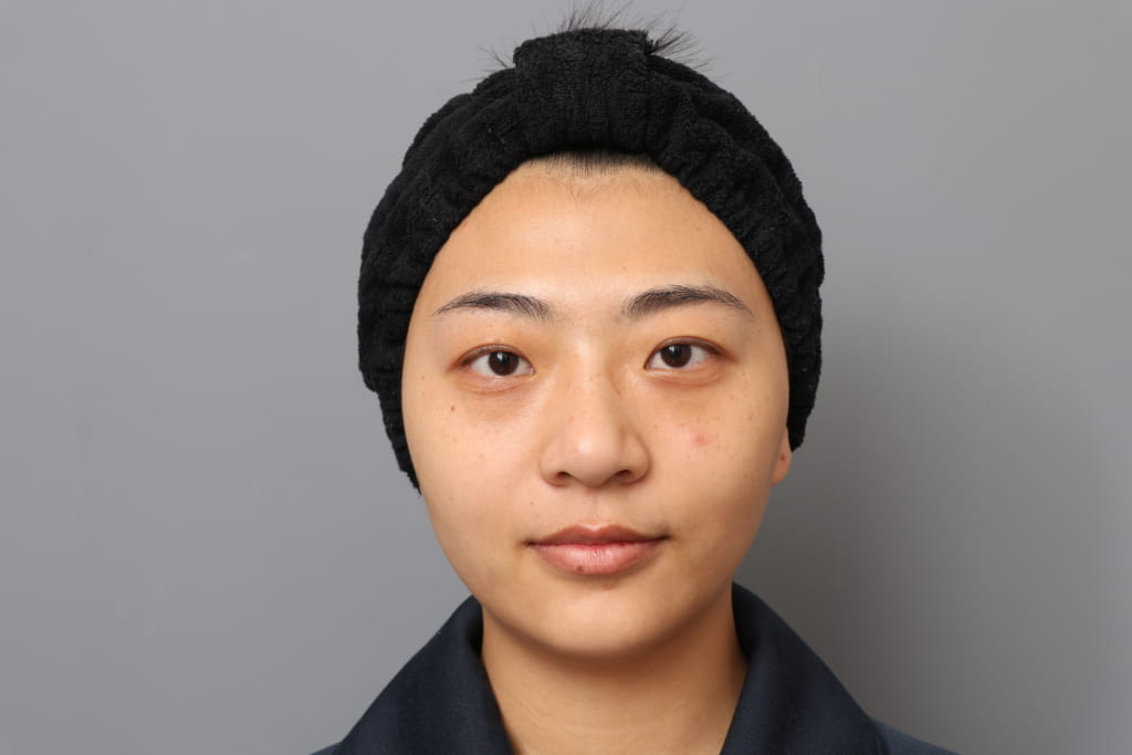 『おでこを丸く(CRF注入)』、20代女性のエイジング治療