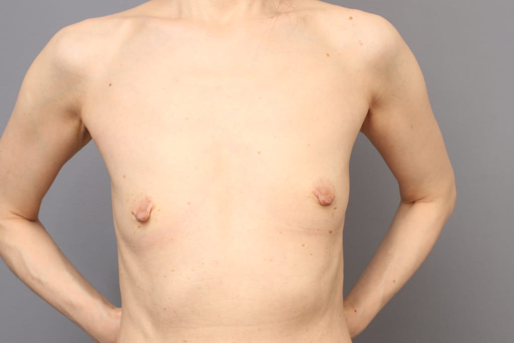 「BMI 18.7、50代女性」の『コンデンスリッチ豊胸』&『乳頭縮小術』