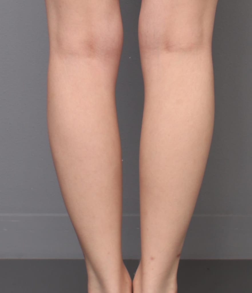 「BMI 18.3、20代女性」の『下腿・足首ベイザー脂肪吸引』