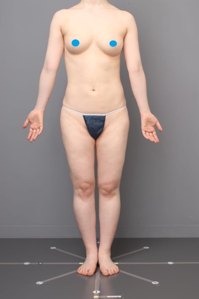 「BMI 21.2、30代女性」の『全腹＋腰のベイザー脂肪吸引』