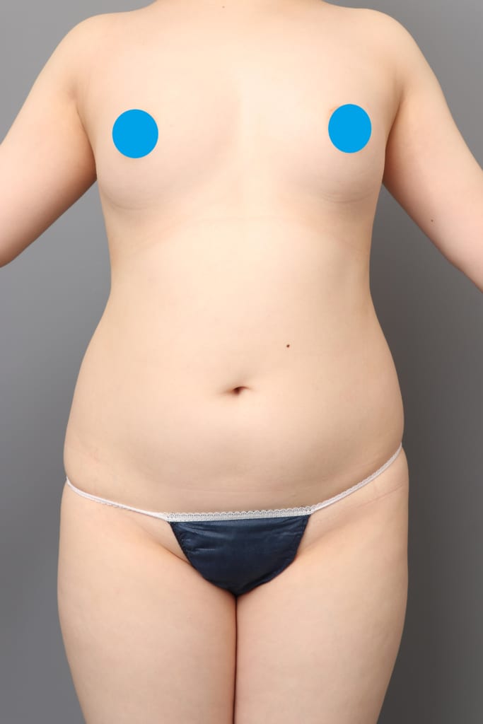 「BMI 24、20代女性」の『全腹＋胸下のベイザー脂肪吸引』