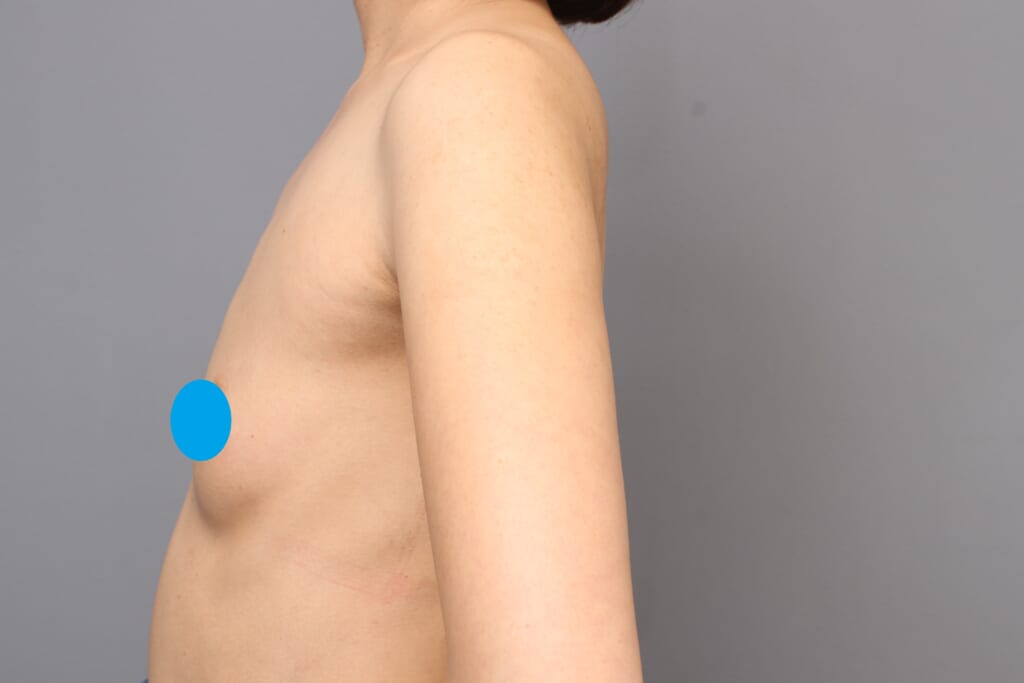 「BMI 19.2、30代女性」の『コンデンスビブラ豊胸』 ~~最強ツール、乳房拡張機器「BEbra(ビブラ)」④~~