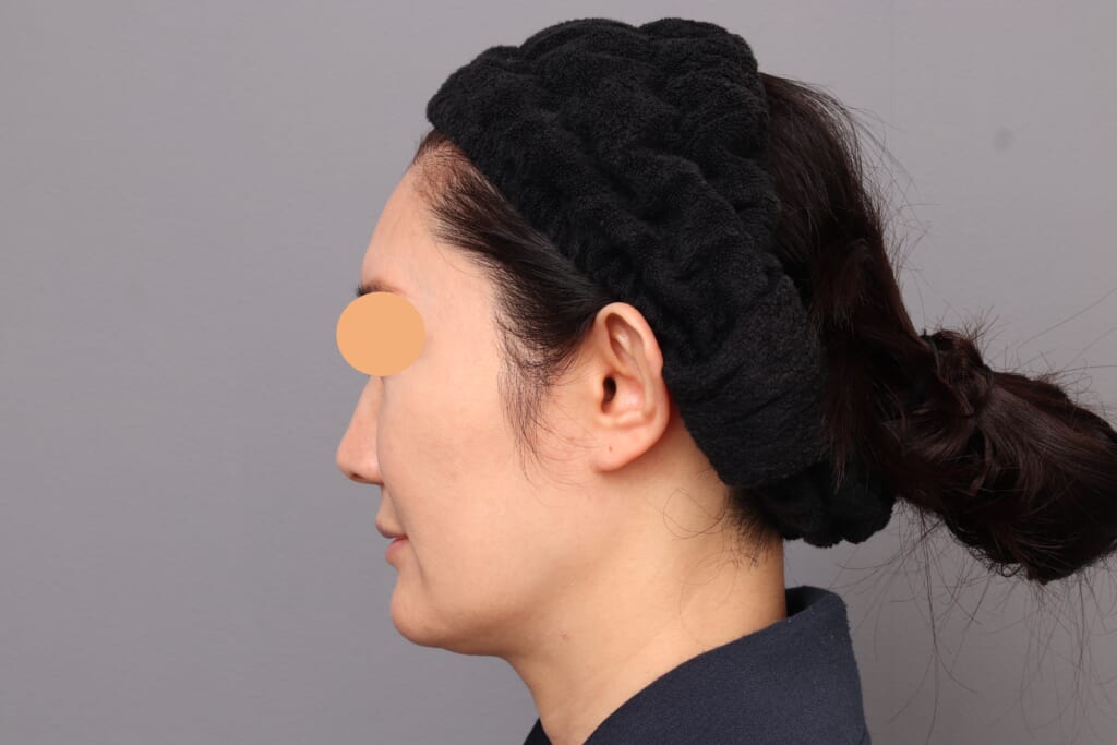 脂肪注入でナチュラルに若返り