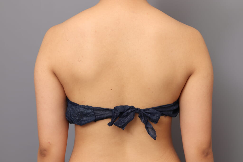 「BMI 21、20代女性」の『二の腕・肩のベイザー脂肪吸引』