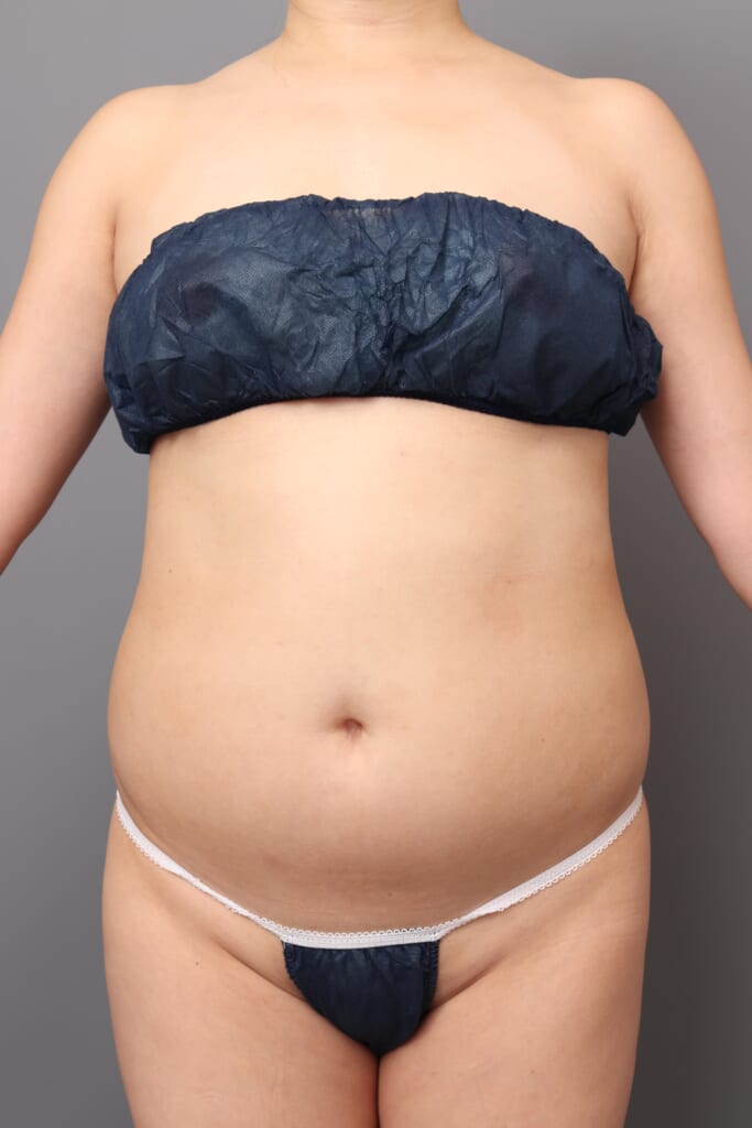 「BMI 21.9、40代女性」の『腹部全体のベイザー脂肪吸引』～術後のトレーニングでNice Bodyに激変！！～