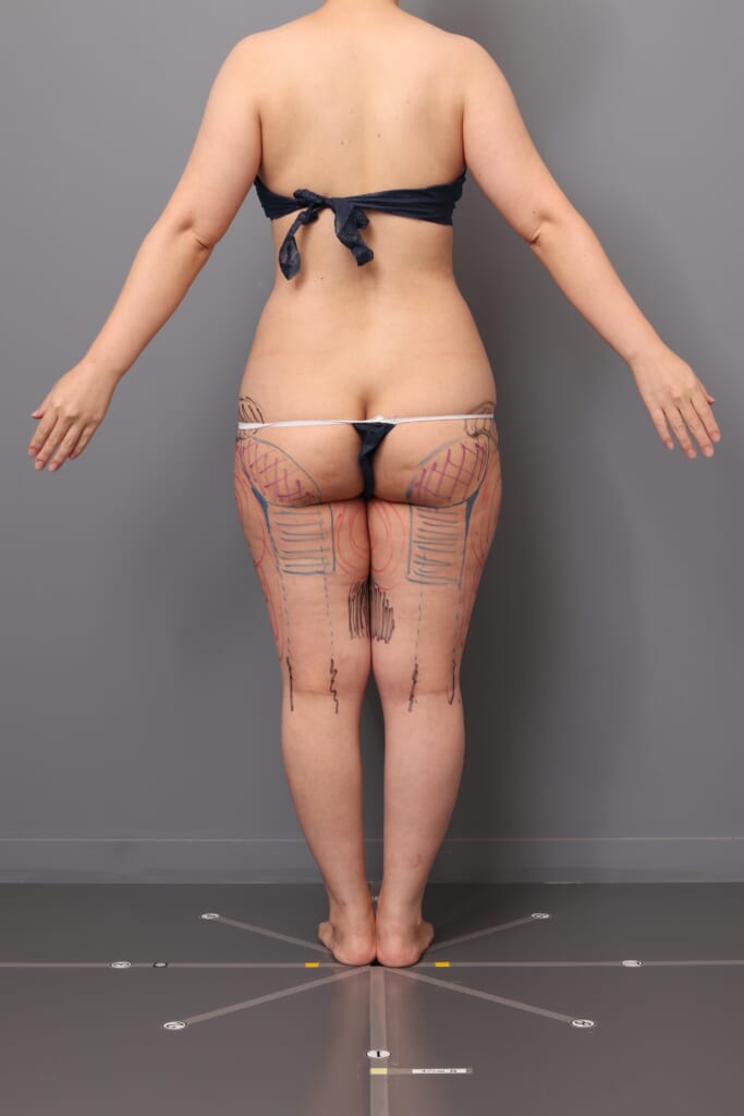 「BMI 22.8、30代女性」の『大腿内・外のベイザー脂肪吸引』～キュッとヒップアップ効果も～