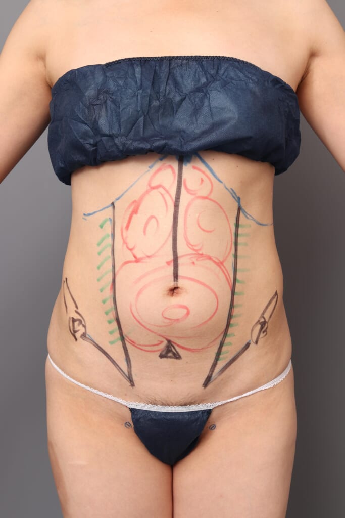 「BMI 20.9、40代女性」の『上・下腹部のベイザー脂肪吸引』～ぽっこり下腹部をスッキリと～