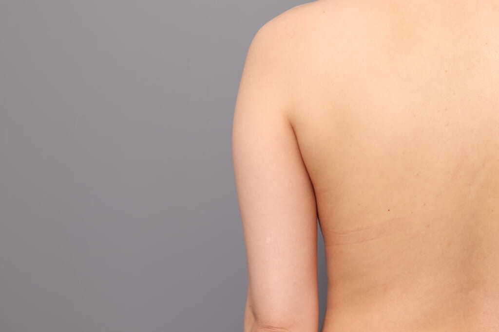 「BMI 21.5、30代女性」の『二の腕・肩のベイザー脂肪吸引』