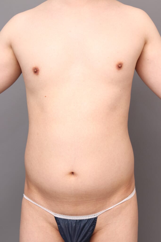「BMI 22.5、20代男性」の『腹部のベイザー脂肪吸引』～ぽっこりお腹をスッキリと～