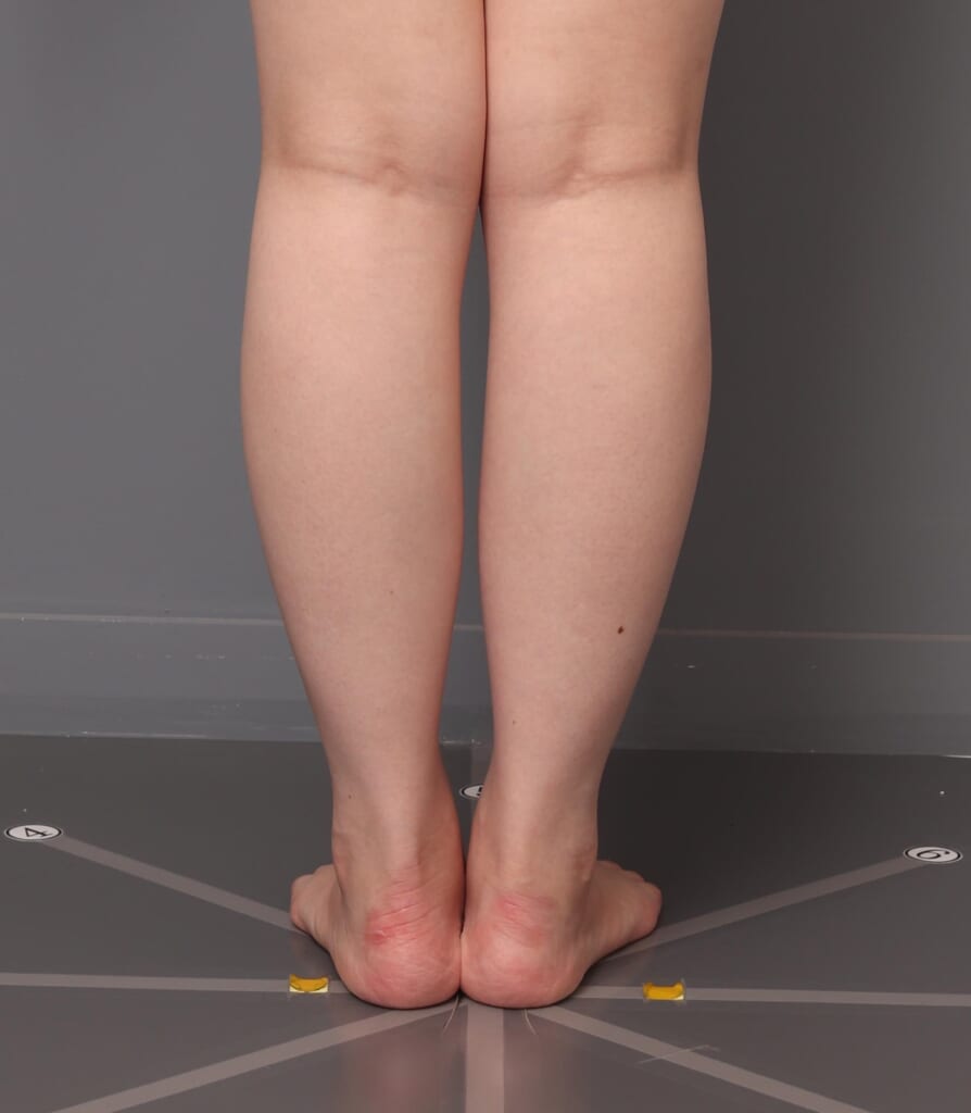 「BMI 19.1、20代女性 」の『下腿・足首のベイザー脂肪吸引』～他院で吸引適応外と言われても。。～