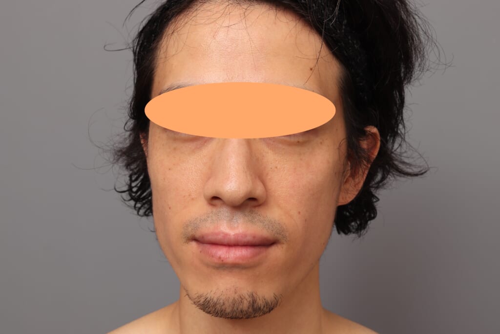 脂肪注入で疲れた印象を改善～頬高、目の下注入～