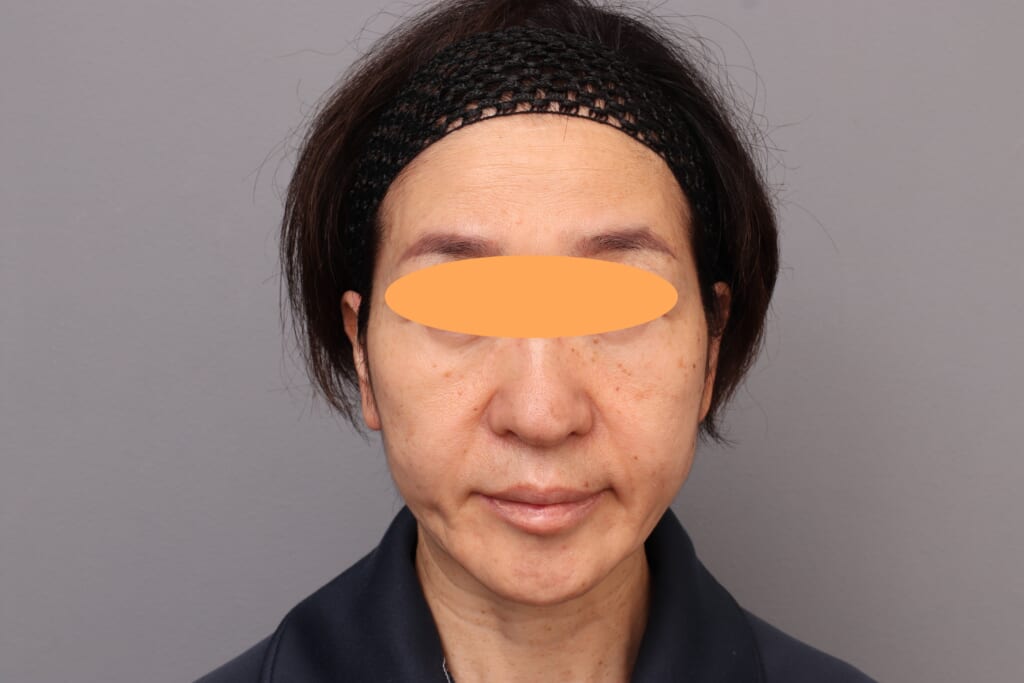 脂肪注入で若々しく～頬高注入～