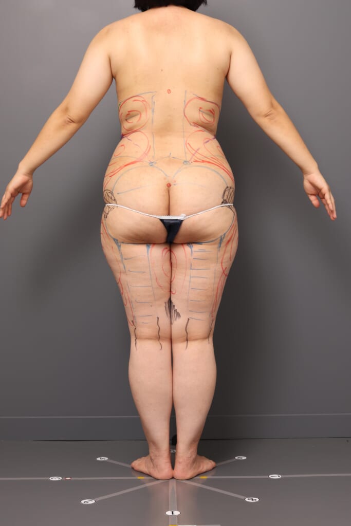 スッキリとした後ろ姿～大腿内・外＋腰＋肩甲骨下のベイザー脂肪吸引～