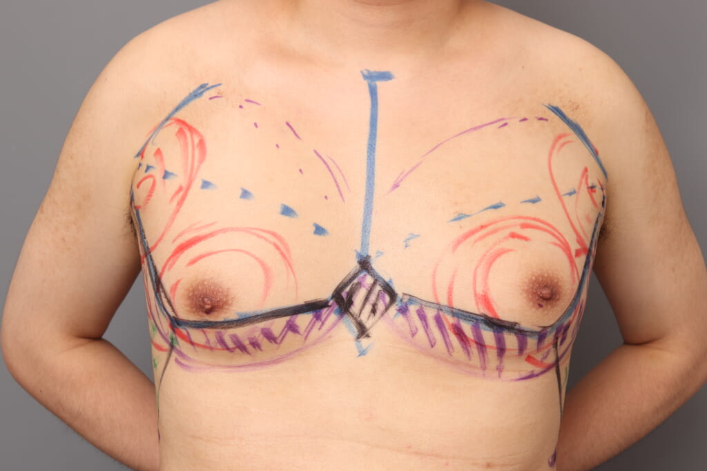女性化乳房のふくらみ撃退～胸部・側胸部のベイザー脂肪吸引～